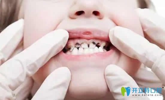 乳牙龋齿怎么治疗