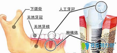 重庆皇仕口腔种植牙图解