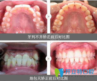 闫路牙齿矫正真人案例