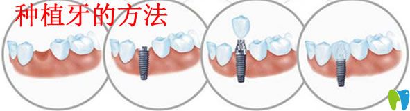 种植牙的方法