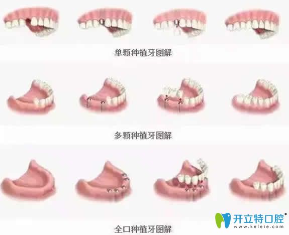 种植牙适合哪些人