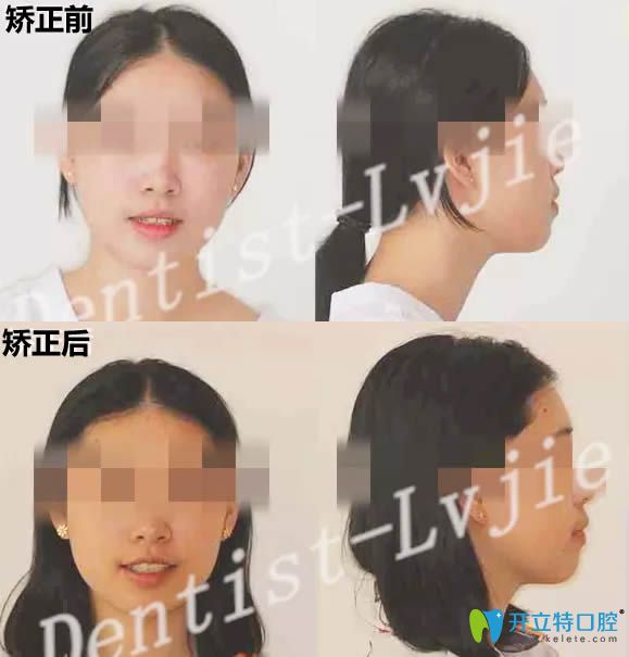 北京圣贝口腔28岁顾客牙齿矫正案例 来看正畸前后对比照片
