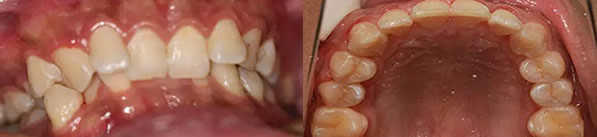 请看我在福州登特口腔金属托槽牙齿矫正14个月的恢复过程