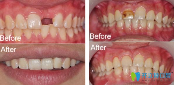 维乐口腔种植牙及色素牙修复效果对比图
