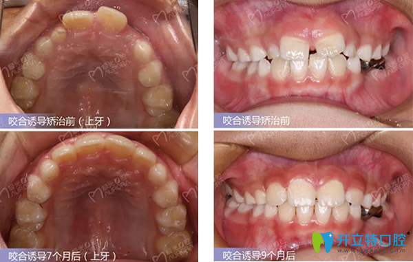 成都极光口腔正畸效果案例