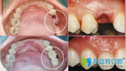 北京齿泰华口腔门诊种植牙效果对比图