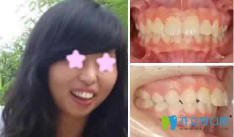 龅牙妹在昆明尚爱韩美口腔做牙齿矫正一年后红遍朋友圈