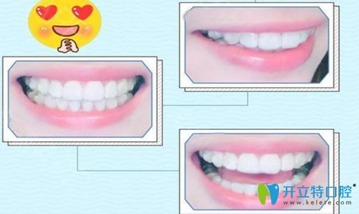去广州欧顿口腔做隐性矫正第650天效果图