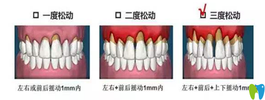 牙齿松动治疗办法和松动程度有关