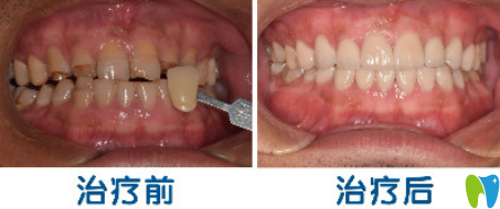 欢悦口腔3D超薄瓷贴面修复牙齿案例