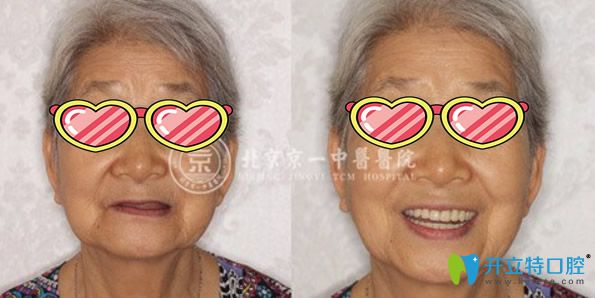 62岁杨奶奶在北京京一口腔种植全口牙后