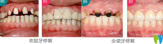 珠海爱思特韩继新院长牙齿修复案例