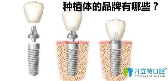 国产种植牙价格
