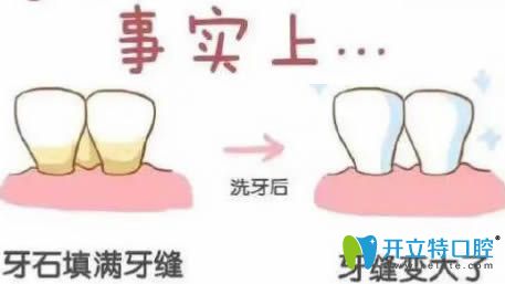 开立特口腔网：洗牙会导致牙缝变大吗？