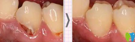 泉州补牙哪家好？来看牙博士口腔补牙治疗前后对比案例