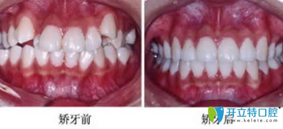 牙齿拥挤矫正前后对比照片