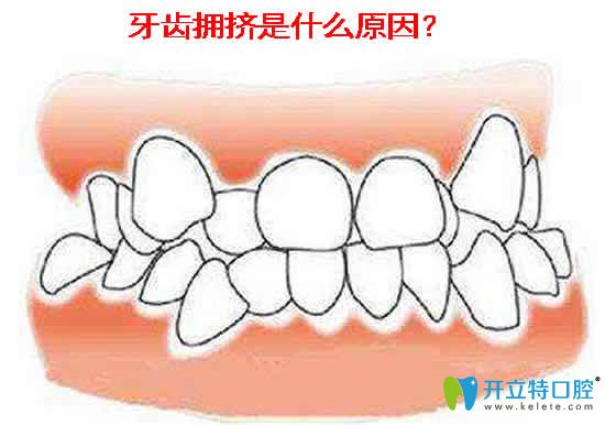 牙齿拥挤不齐怎么矫正 提供矫正方法及矫正前后对比照片