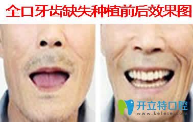 北京美冠塔口腔方雅红全口种植牙效果图