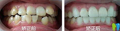 诚之康口腔儿童矫正效果图