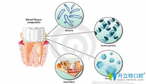 牙菌斑形成图示