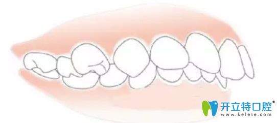 单纯牙性龅牙图片