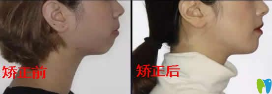 公布我龅牙+嘴巴合不拢 在广州优典口腔做牙齿矫正前后照片