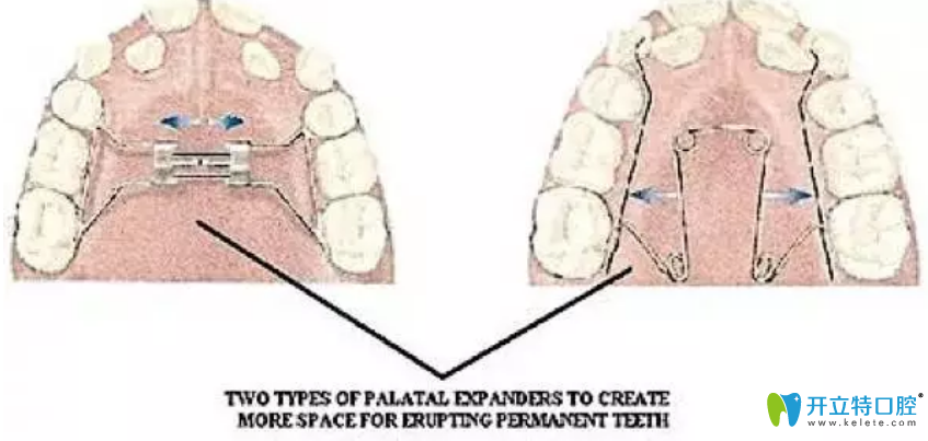 腭扩张器（上颌扩张器）