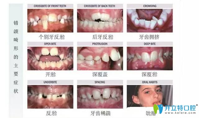 儿童什么样的牙齿问题需要越早矫正越好