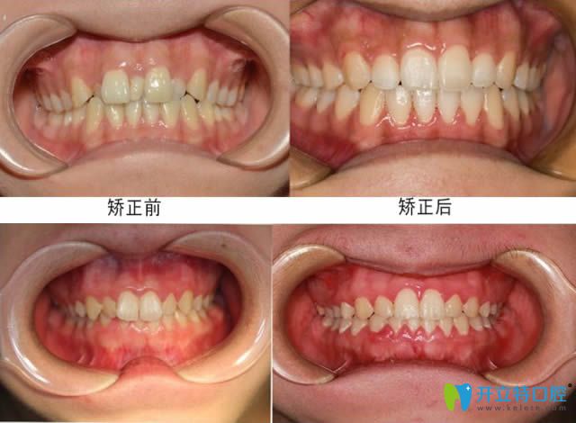 上海圣贝凌姿医生牙齿拥挤矫正及深复合牙齿矫正病例