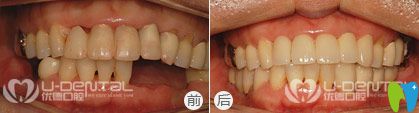 西安优德口腔微创无痛种植牙案例图