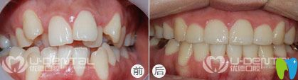 优德口腔隐形矫正案例效果图