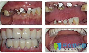 泰州北极星口腔种植牙前后对比图