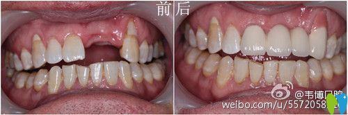 深圳韦博口腔种植牙对比图