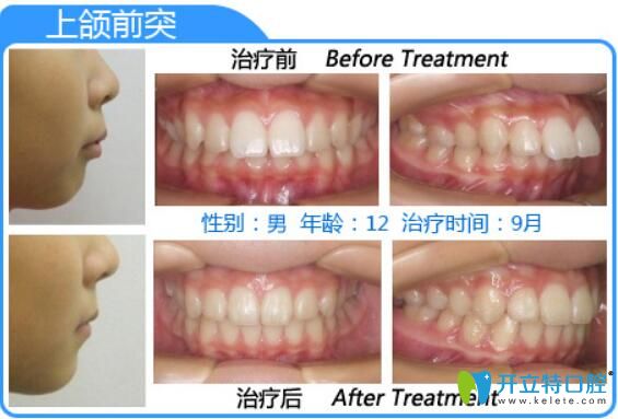 深圳格伦菲尔口腔朱明璋龅牙矫正案例前后对比图