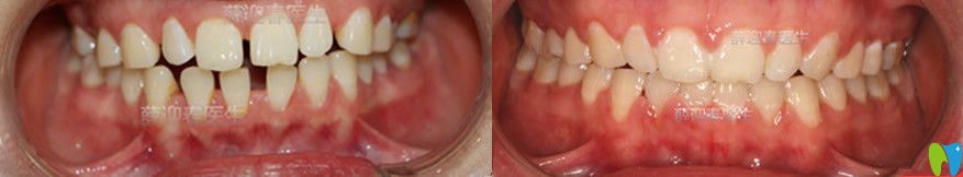 半隐形陶瓷矫正前后对比图