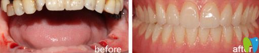 重庆牙博士口腔种植牙效果图