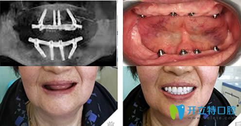 沈阳欢乐仁爱口腔全口牙种植案例效果对比图