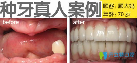 无锡北极星口腔种植牙真人案例效果图