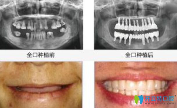 全口种植牙前后对比图