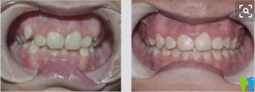 周骅医生成人时代天使隐形矫正前后对比效果
