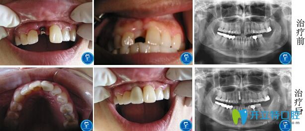 北京京通口腔单颗牙缺失即刻种植案例