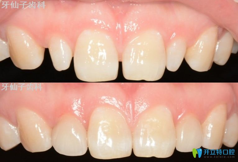 牙仙子齿科牙齿贴面修复前后对比图