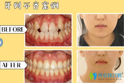 金华芘丽芙口腔青少年牙列不齐矫正后对比照