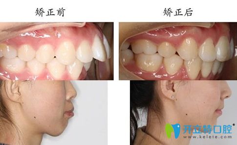 泰州北极星口腔牙齿矫正案例效果