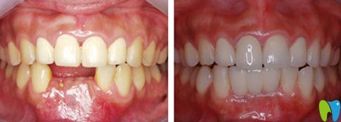 北极星口腔种植牙前后对比图