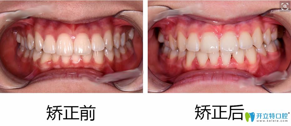 深覆颌牙齿矫正前后对比效果图