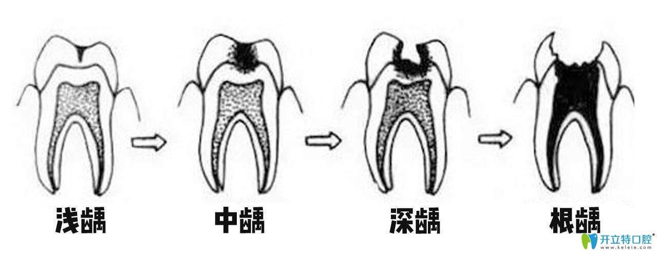 宝宝的蛀牙如何治疗具体要看牙齿龋坏的程度