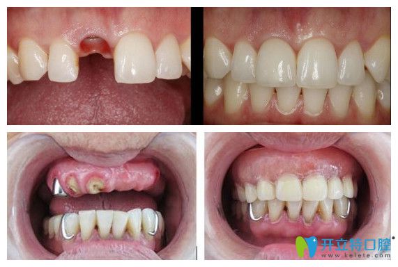 中诺口腔单颗牙种植 半口牙种植真人案例前后效果对比图