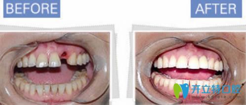 西安诺贝尔单颗牙缺失案例对比效果图