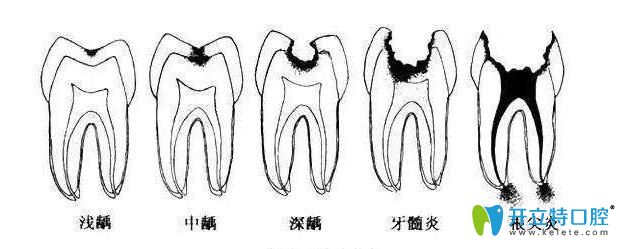 牙齿疼痛不一样是因为牙坏的程度不一样